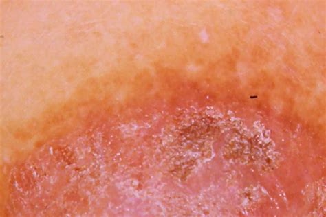 dry skin in breast|eczema on chest pictures.